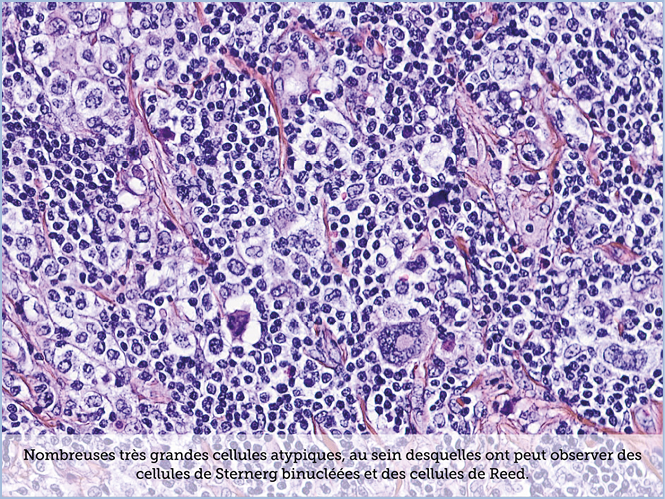 FICHE 2 TUMEUR WARTHIN ECRAN B