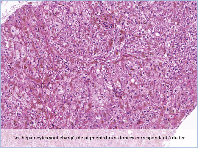 FICHE 2 TUMEUR WARTHIN ECRAN A