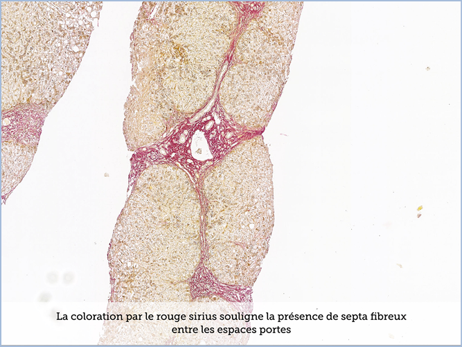 FICHE 2 TUMEUR WARTHIN VIDEO