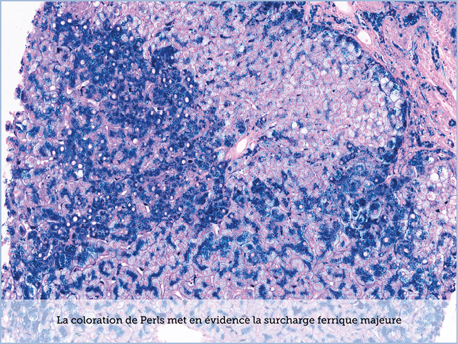 FICHE 2 TUMEUR WARTHIN ECRAN C