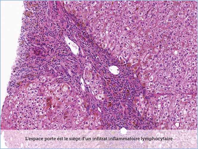 FICHE 2 TUMEUR WARTHIN ECRAN B