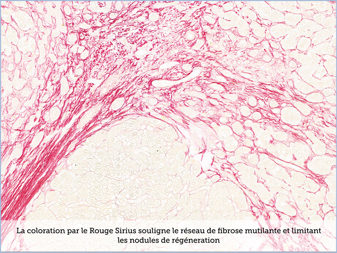 FICHE 2 TUMEUR WARTHIN VIDEO