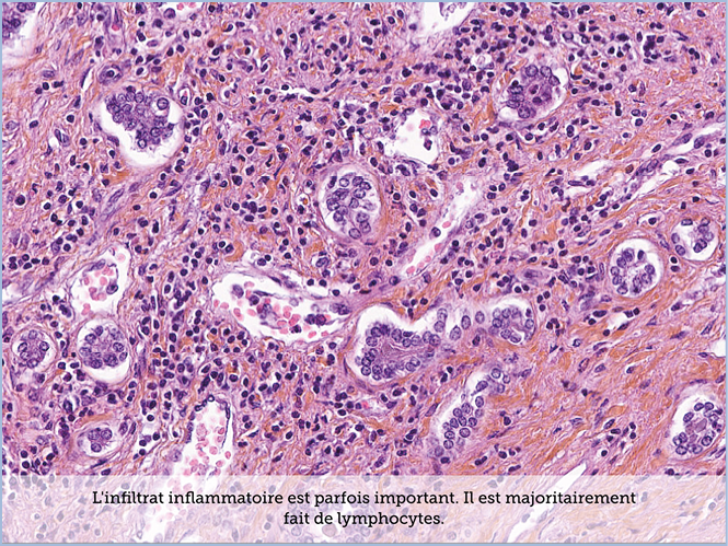 FICHE 2 TUMEUR WARTHIN ECRAN C