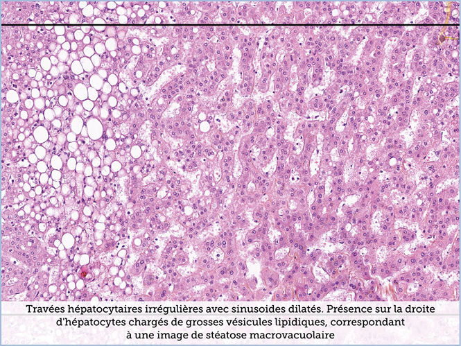 FICHE 2 TUMEUR WARTHIN ECRAN B
