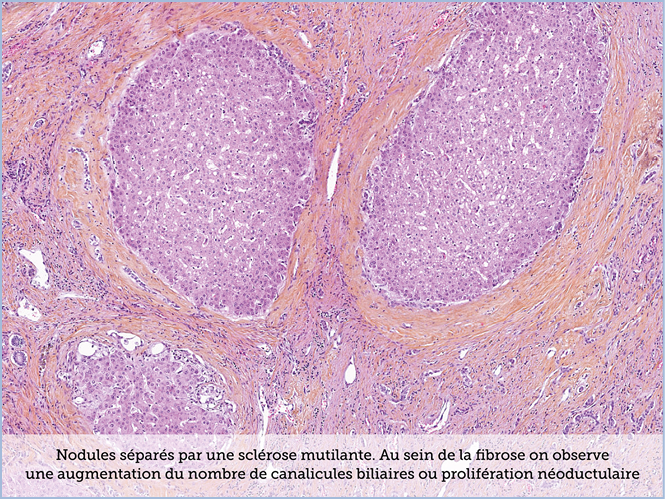 FICHE 2 TUMEUR WARTHIN ECRAN A