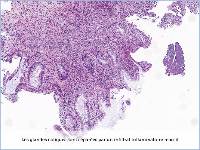 FICHE 2 TUMEUR WARTHIN ECRAN A