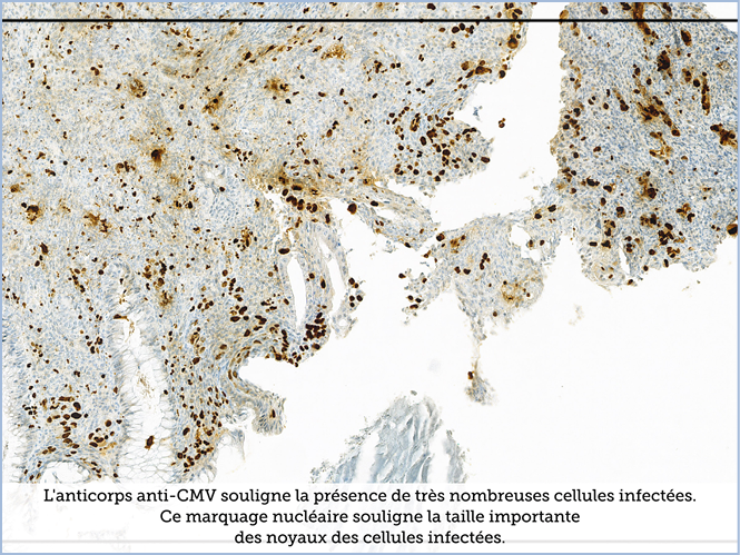 FICHE 2 TUMEUR WARTHIN ECRAN C