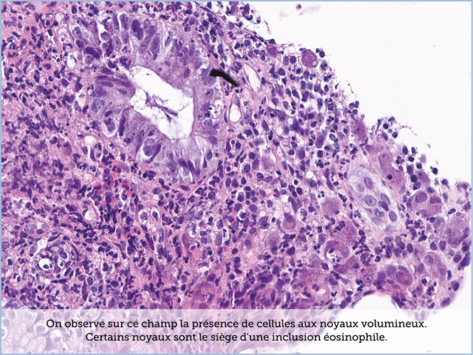 FICHE 2 TUMEUR WARTHIN ECRAN B