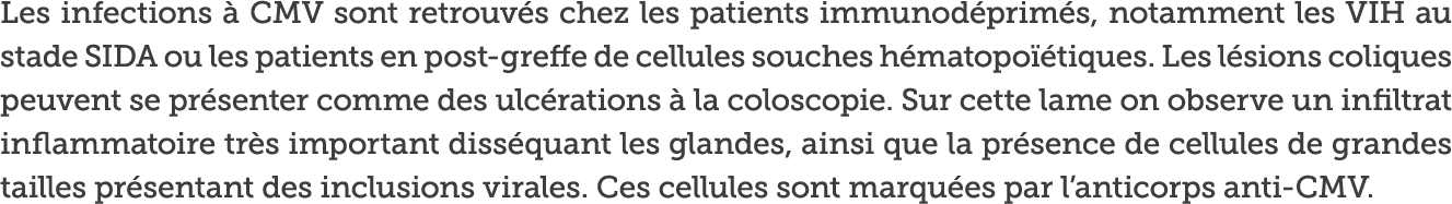 Les infections   CMV sont retrouv s chez les patients immunod prim s  notamment les VIH au stade SIDA ou les patients   