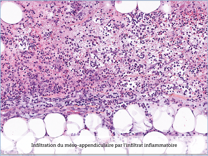FICHE 2 TUMEUR WARTHIN VIDEO