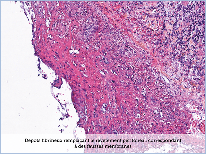 FICHE 2 TUMEUR WARTHIN ECRAN C