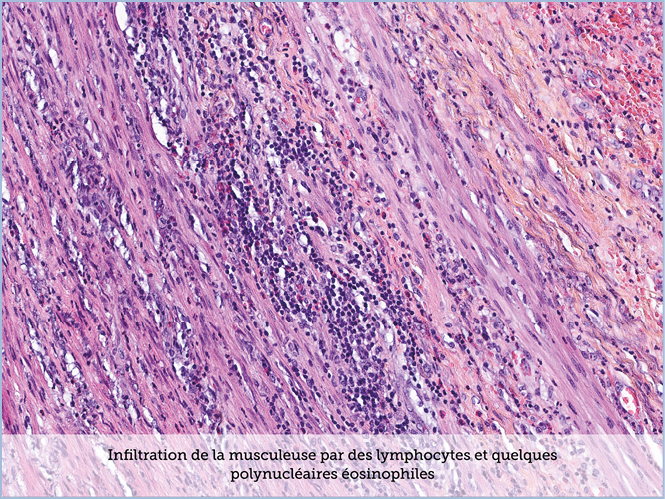 FICHE 2 TUMEUR WARTHIN ECRAN B