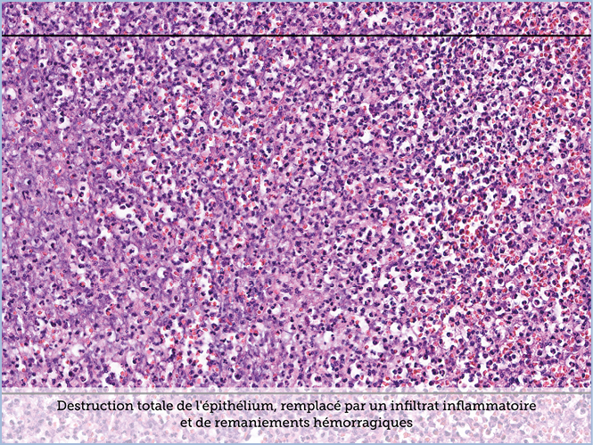FICHE 2 TUMEUR WARTHIN ECRAN A