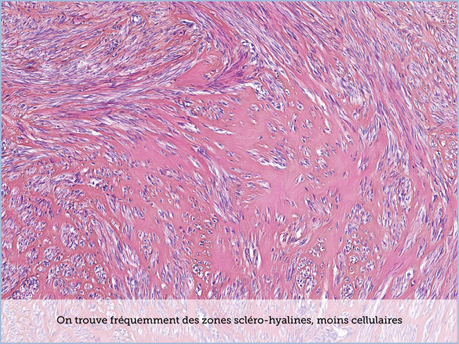 FICHE 2 TUMEUR WARTHIN ECRAN C