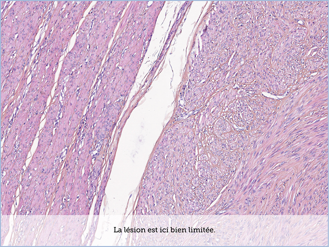 FICHE 2 TUMEUR WARTHIN ECRAN B