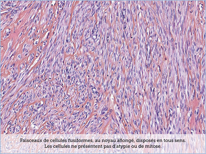 FICHE 2 TUMEUR WARTHIN ECRAN A