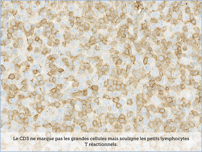 FICHE 2 TUMEUR WARTHIN VIDEO