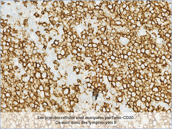 FICHE 2 TUMEUR WARTHIN ECRAN C