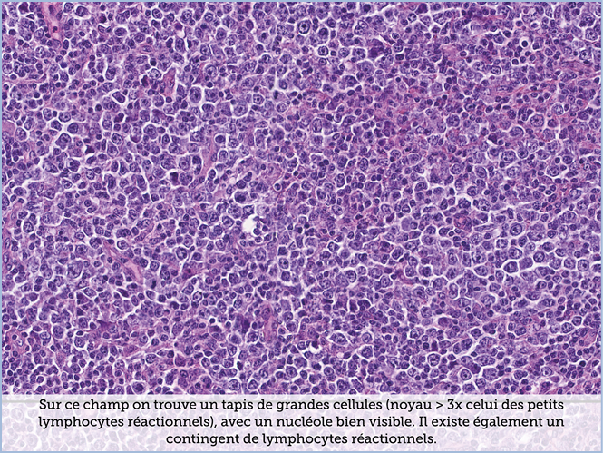 FICHE 2 TUMEUR WARTHIN ECRAN B