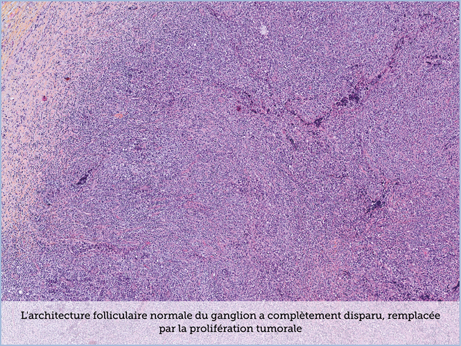 FICHE 2 TUMEUR WARTHIN ECRAN A