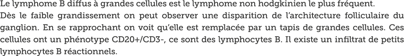 Le lymphome B diffus   grandes cellules est le lymphome non hodgkinien le plus fr quent  D s le faible grandissement    