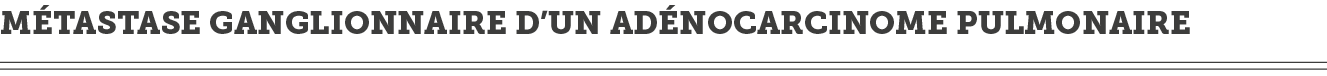 M tastase ganglionnaire d un ad nocarcinome pulmonaire 