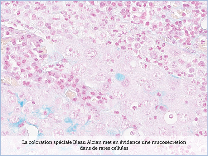 FICHE 2 TUMEUR WARTHIN VIDEO