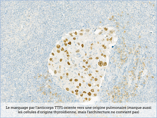 FICHE 2 TUMEUR WARTHIN ECRAN C