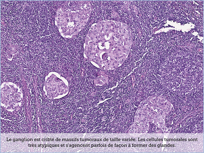 FICHE 2 TUMEUR WARTHIN ECRAN B