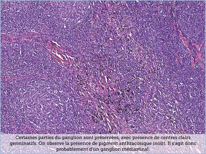 FICHE 2 TUMEUR WARTHIN ECRAN A