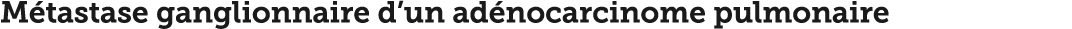 M tastase ganglionnaire d un ad nocarcinome pulmonaire 