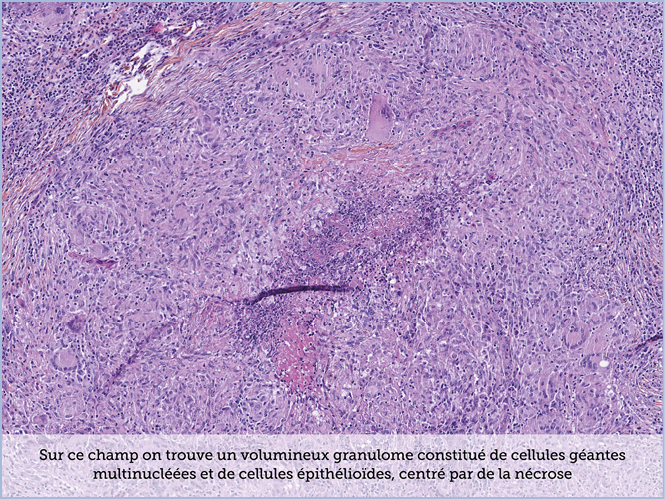 FICHE 2 TUMEUR WARTHIN ECRAN A