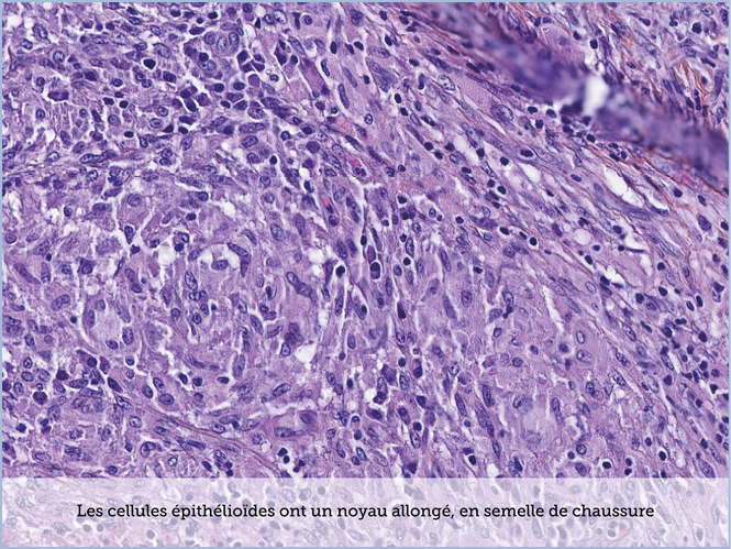 FICHE 2 TUMEUR WARTHIN ECRAN C