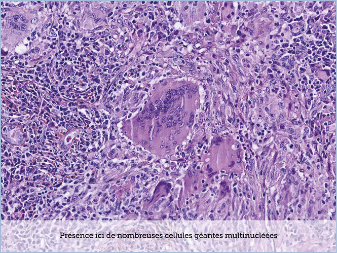 FICHE 2 TUMEUR WARTHIN ECRAN B