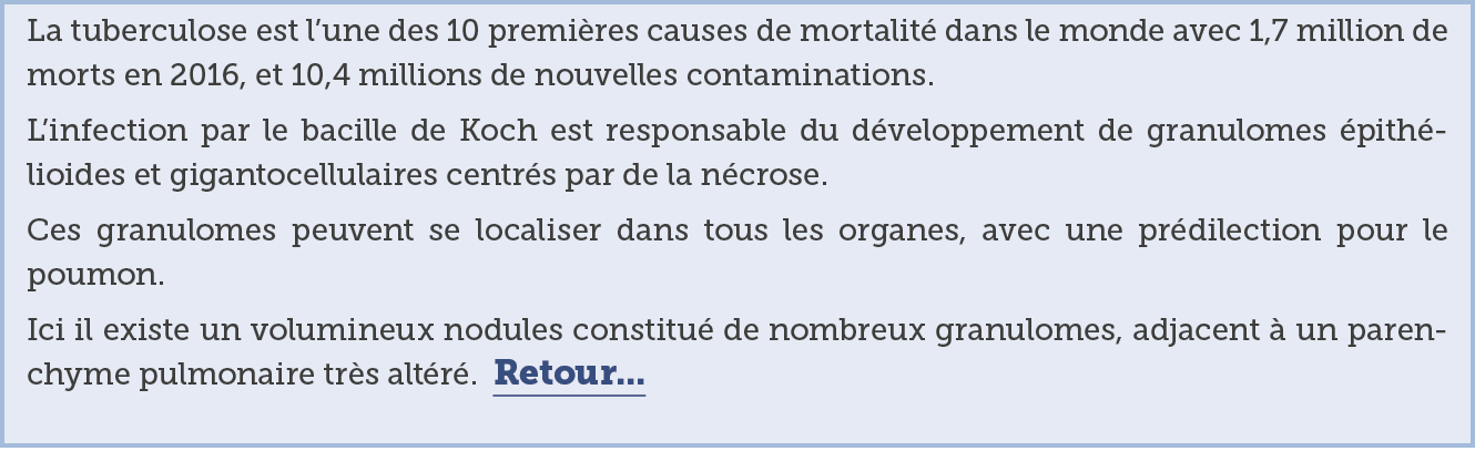 La tuberculose est l une des 10 premi res causes de mortalit  dans le monde avec 1 7 million de morts en 2016  et 10    