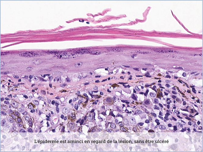 FICHE 2 TUMEUR WARTHIN ECRAN C