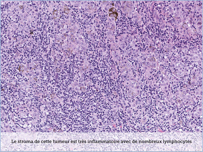 FICHE 2 TUMEUR WARTHIN ECRAN B