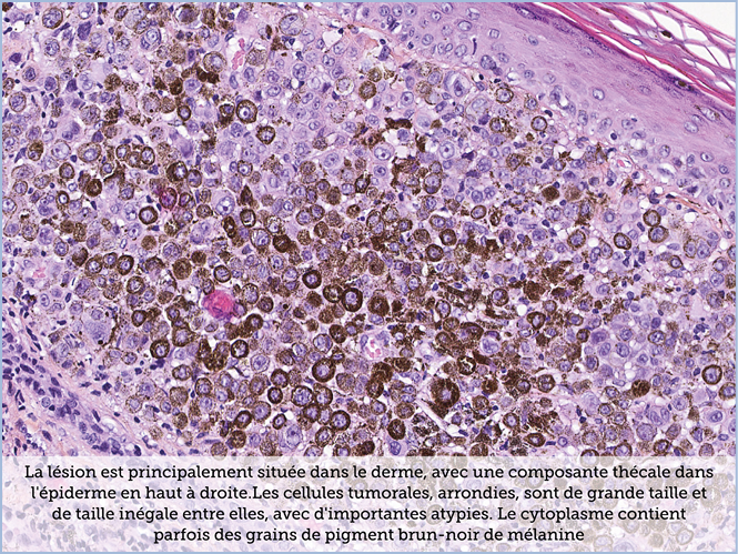 FICHE 2 TUMEUR WARTHIN ECRAN A