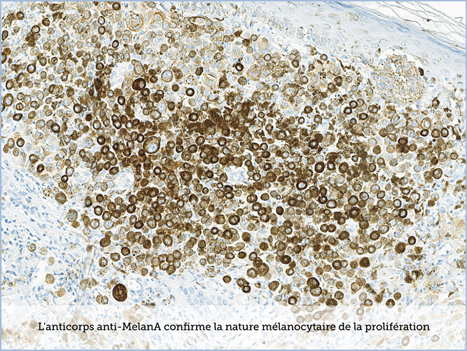 FICHE 2 TUMEUR WARTHIN VIDEO