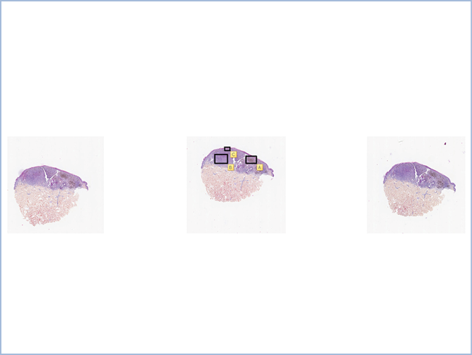 FICHE 2 TUMEUR WARTHIN VIDEO